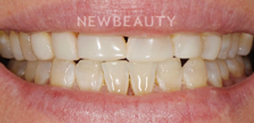 Dr. Salvator La Mastra – Smile Makeover – 46107063 - Before