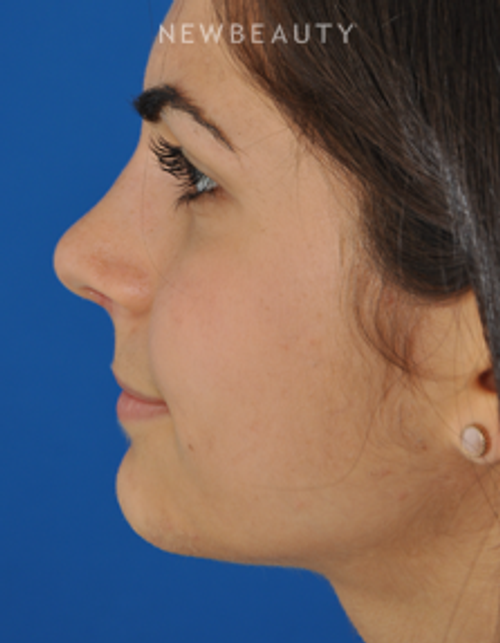 Dr. Edward Kwak - Rhinoplasty - After