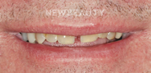 Dr. Salvator La Mastra - Smile Makeover-46106784 - Before