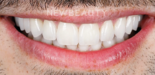 Dr. Husam Almunajed - Veneers & Gum Lift - 49692827 - After