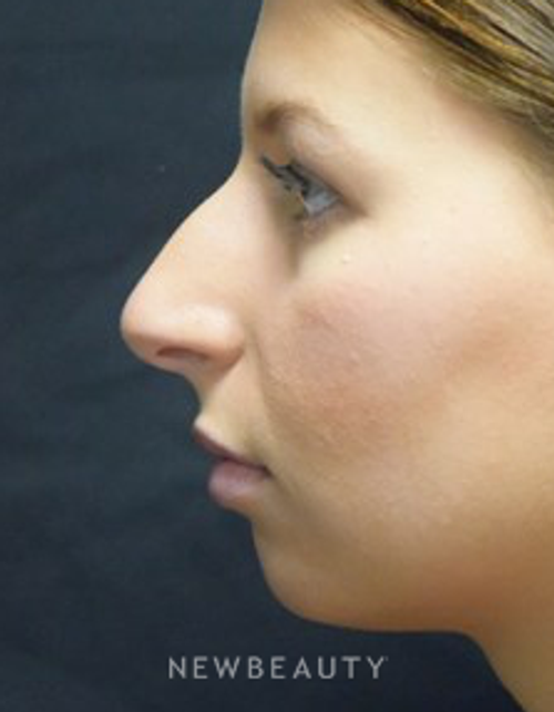 Dr. Jeffrey B. Wise - Rhinoplasty - Before