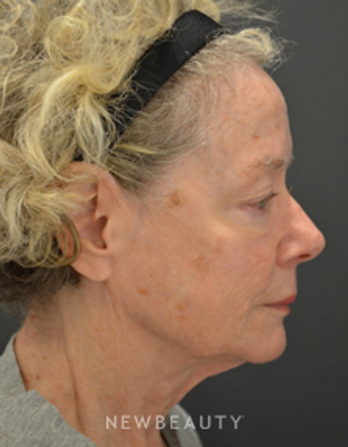 Dr. Aviva Preminger - Facelift - Before