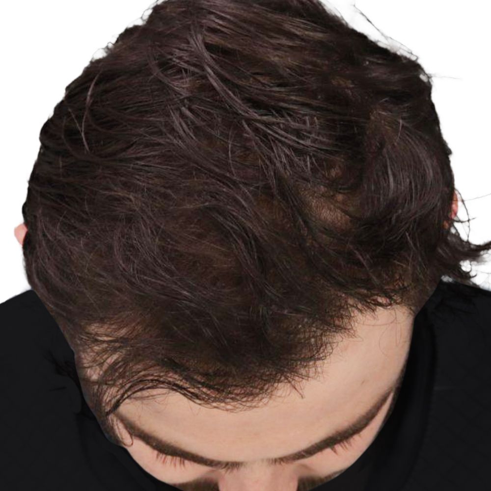 After hair transplant