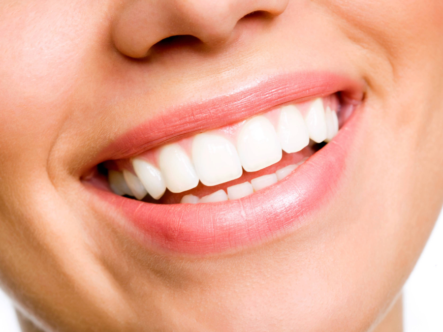 woman smiling with perfect teeth
