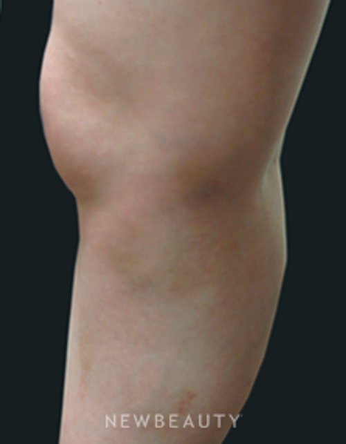 Dr. Jody Levine Vein Treatments - After