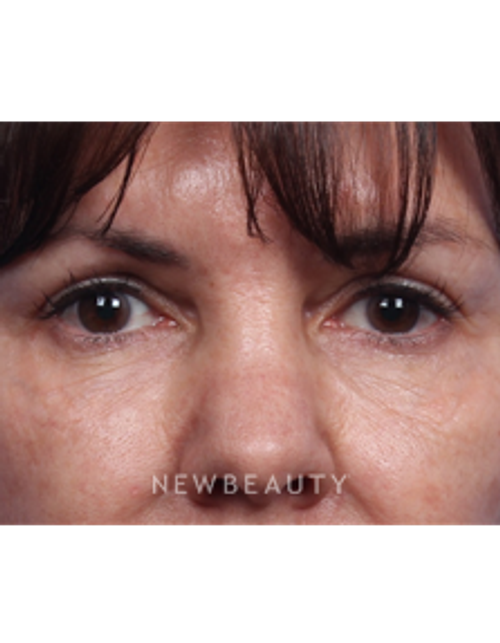 Dr. Kelly Bomer - Liquid Facelift - After