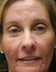 Dr. Kenneth Beer Injectables & Fillers, IPL Lasers - Before