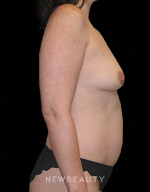Dr. Carmen Kavali Breast Augmentation, Implants, Liposuction, Mommy Makeover, Tummy Tuck - Before