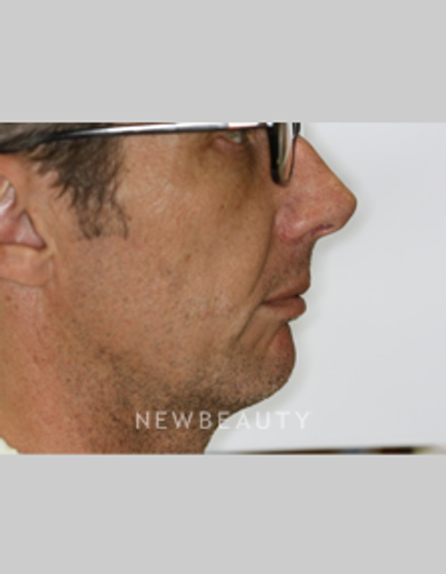 Dr. Bob Perkins Orthodontics - Before