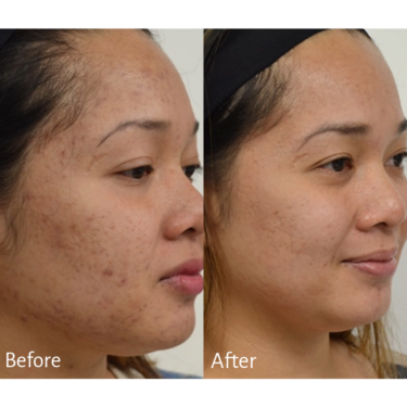 Microneedling Before and After Image / Julie Russak