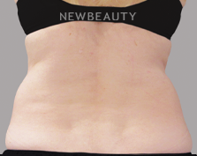 Dr. Lily Lee - CoolSculpting - Before