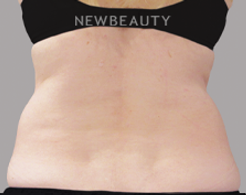 Dr. Lily Lee - CoolSculpting - Before