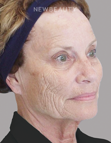 Dr. E. Gaylon McCollough - Ageless Elegance - 44692894 - Before