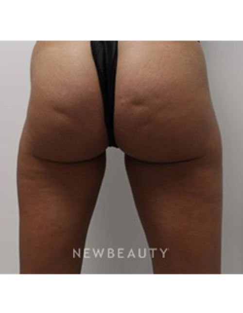 Dr. Julia Russak- Cellulite Treatment - Before