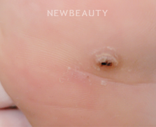 Dr. Anna Chacon - Warts - 34278788 - Before