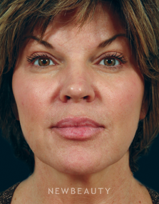 Dr. Kenneth Beer - Restylane - Before