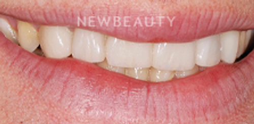 Dr. Salvator La Mastra – Smile Makeover – 46107075 - Before
