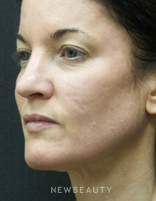 Dr. Jody Levine - Injectables and Fillers - After