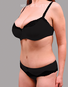 Dr. Shahin Fazilat - Tummy Tuck - 46267460 - After