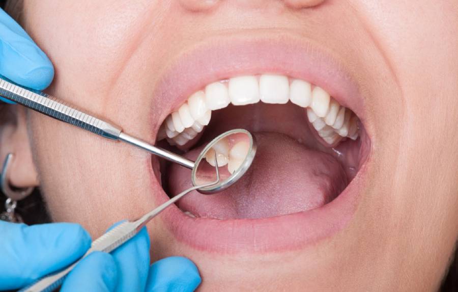 Close-up of an adult's open mouth during a dental exam, with a gloved dentist holding a mirror reflecting a lower molar.