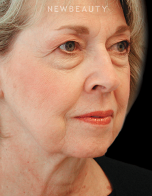 Dr. Henry Mentz - Facelift - Before