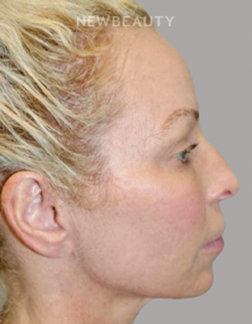 Dr. Sanjay Grover - Rhinoplasty - 49727892 - Before