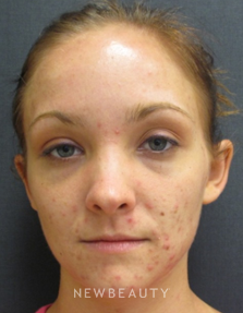 Dr. Janet Allenby - Skin treatments - Before