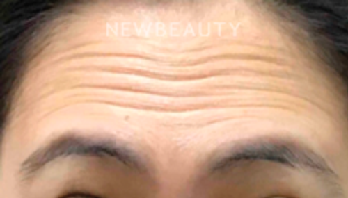 Dr. Elaine Kung - Wrinkle Relaxer - 33036784 - Before