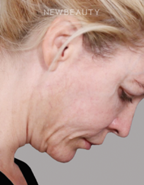 Dr. Paul Nassif - Deep Plane Facelift & Necklift - 51351578 - Before