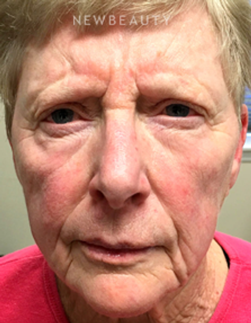 Dr. Mokhtar Asaadi - Facelift - Before