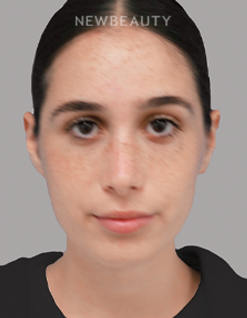 Dr. Michael A. Epstein - Natural-Looking Results - 33109401 - After