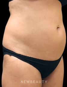 Dr. Janet Allenby - CoolSculpting - Before