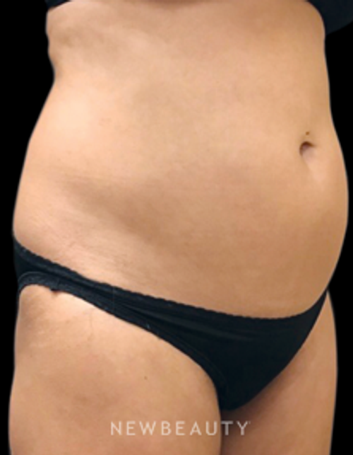 Dr. Janet Allenby - CoolSculpting - Before