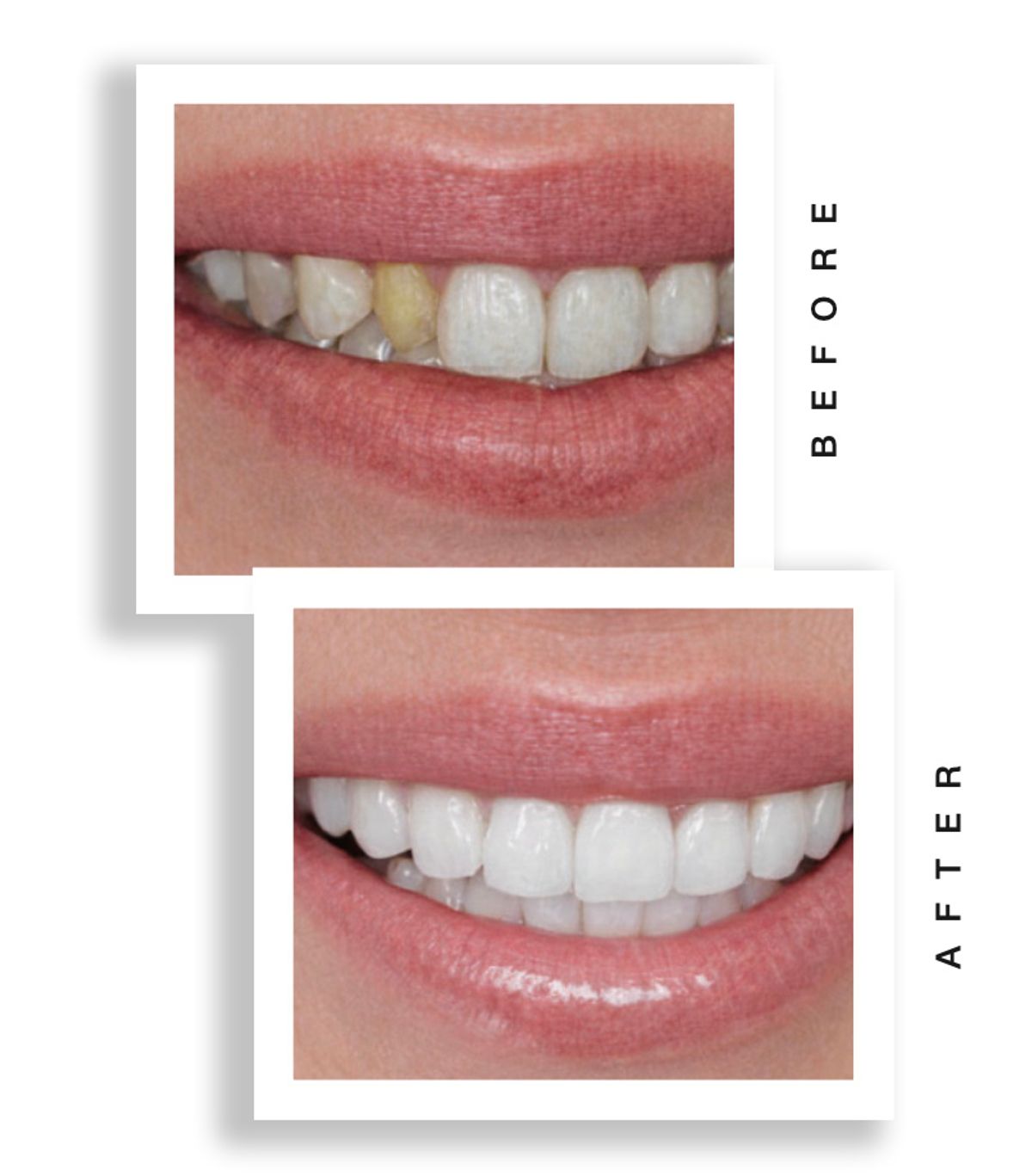 smile before and after