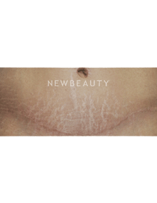 Dr. Kenneth Beer Fraxel Stretchmarks - Before