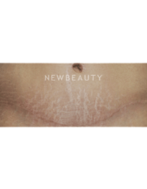 Dr. Kenneth Beer Fraxel Stretchmarks - Before