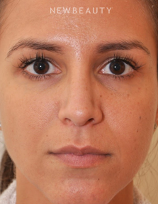 Dr. Edward Kwak - Rhinoplasty - After