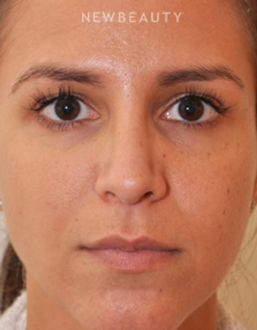 Dr. Edward Kwak - Rhinoplasty - After