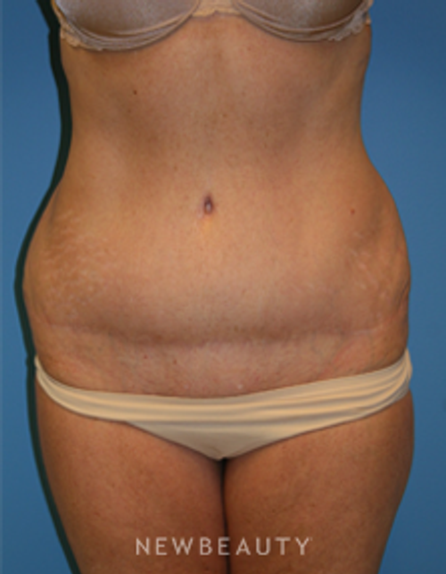 Dr. Christine Hamori Liposuction, Skin TIghtening, Energy-Based - Before