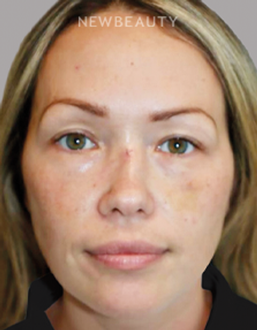 Dr. Sanjay Grover - Rhinoplasty - 49727971 - Before
