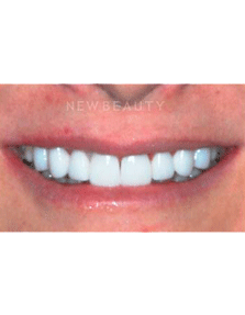 Dr. Guy Lewis Veneers - After