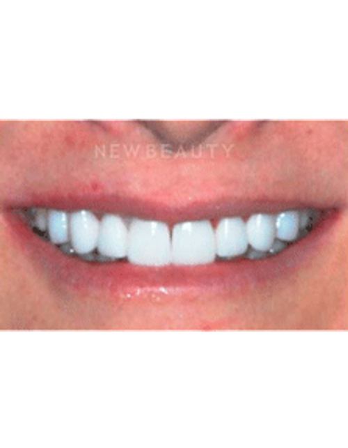 Dr. Guy Lewis Veneers - After