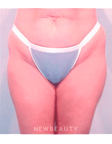 Dr. Henry Mentz Tummy Tuck, Liposuction - Before