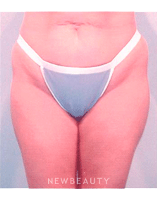 Dr. Henry Mentz Tummy Tuck, Liposuction - Before