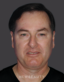 Dr. Mary Herte Eyelift, Injectables & Fillers - Before