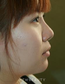 Dr. John Kang - Upper Blepharoplasty & Rhinoplasty - After