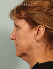 Dr. Kenneth Beer - Kybella - Before