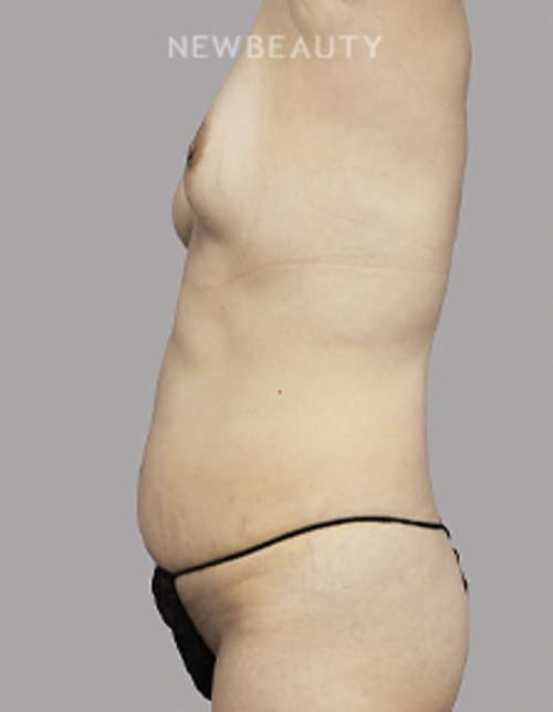 Dr. Andrea Martin - Enhanced Contours - 36658305 - Before