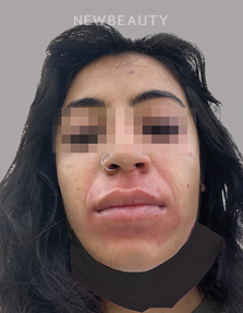 Dr. Anna Chacon - Angioedema - 34276863 - After