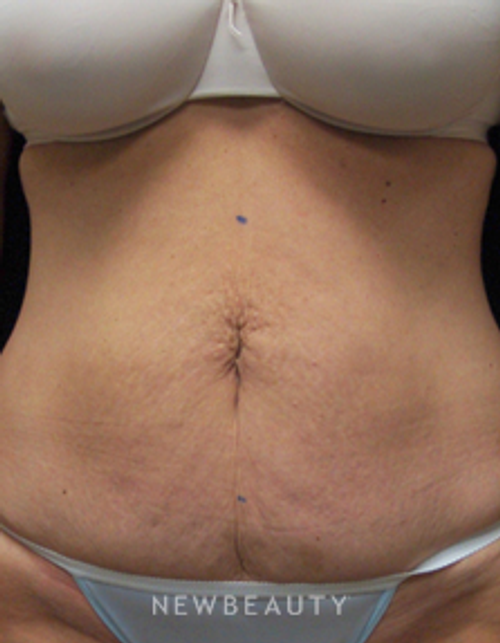 Dr. Mokhtar Asaadi Liposuction, Tummy Tuck - Before